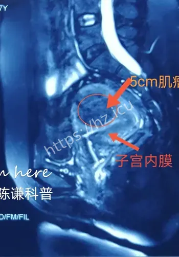 22厘米肌瘤背景补充